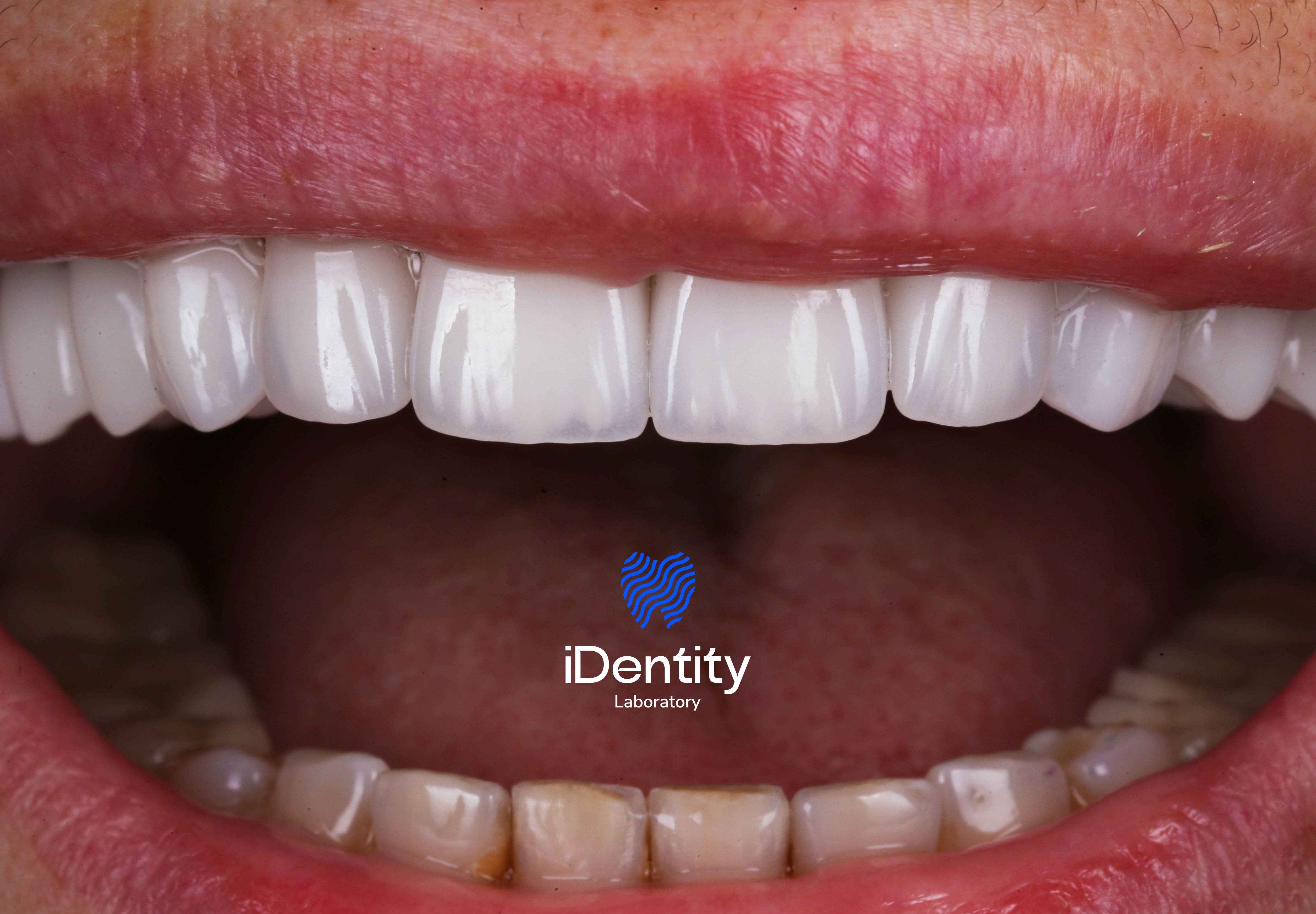 Close-up of open mouth showing bright upper teeth with dental veneers and natural lower teeth with discoloration.