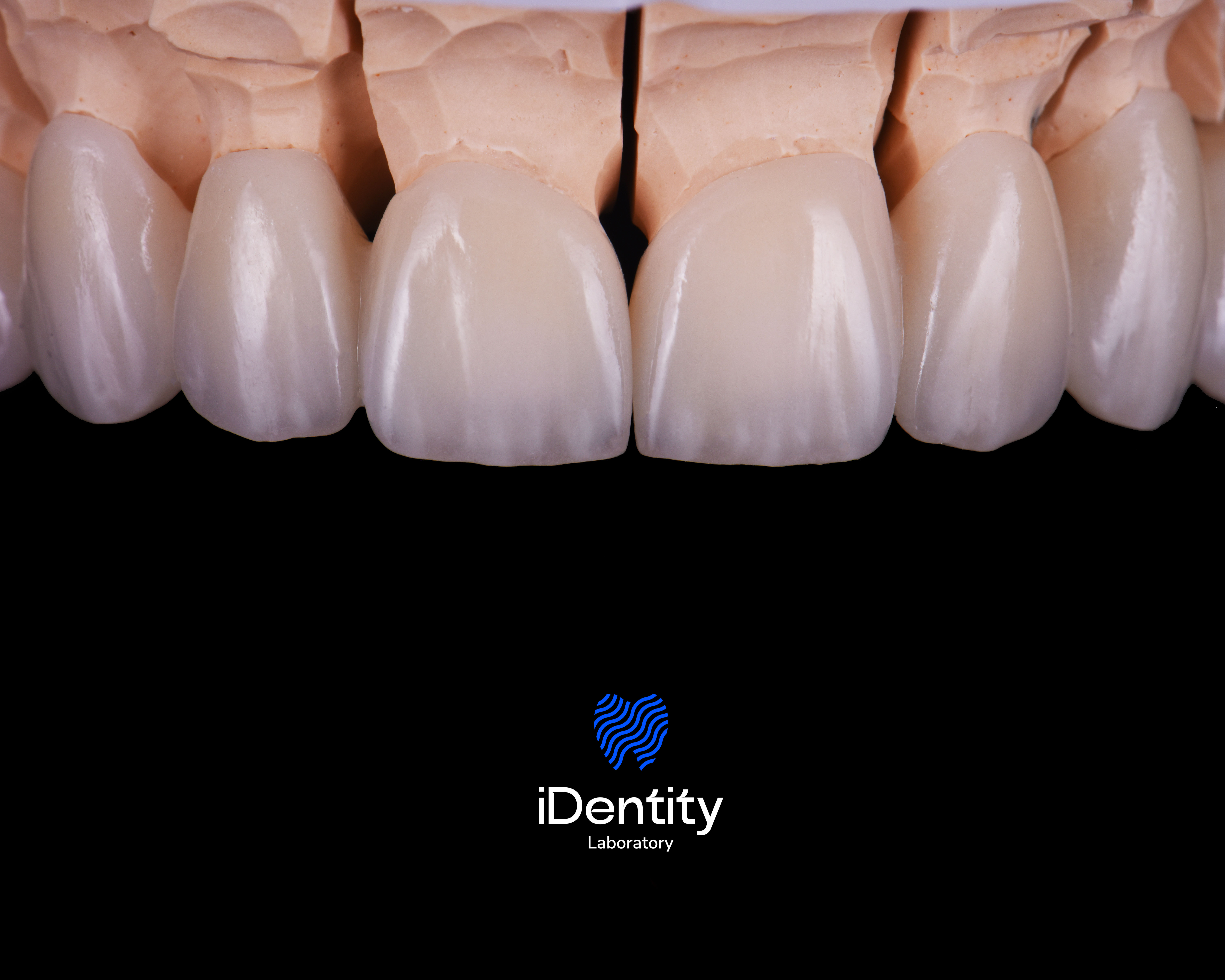 Close-up of dental prosthetic teeth on a model against a black background with iDentity Laboratory logo below.