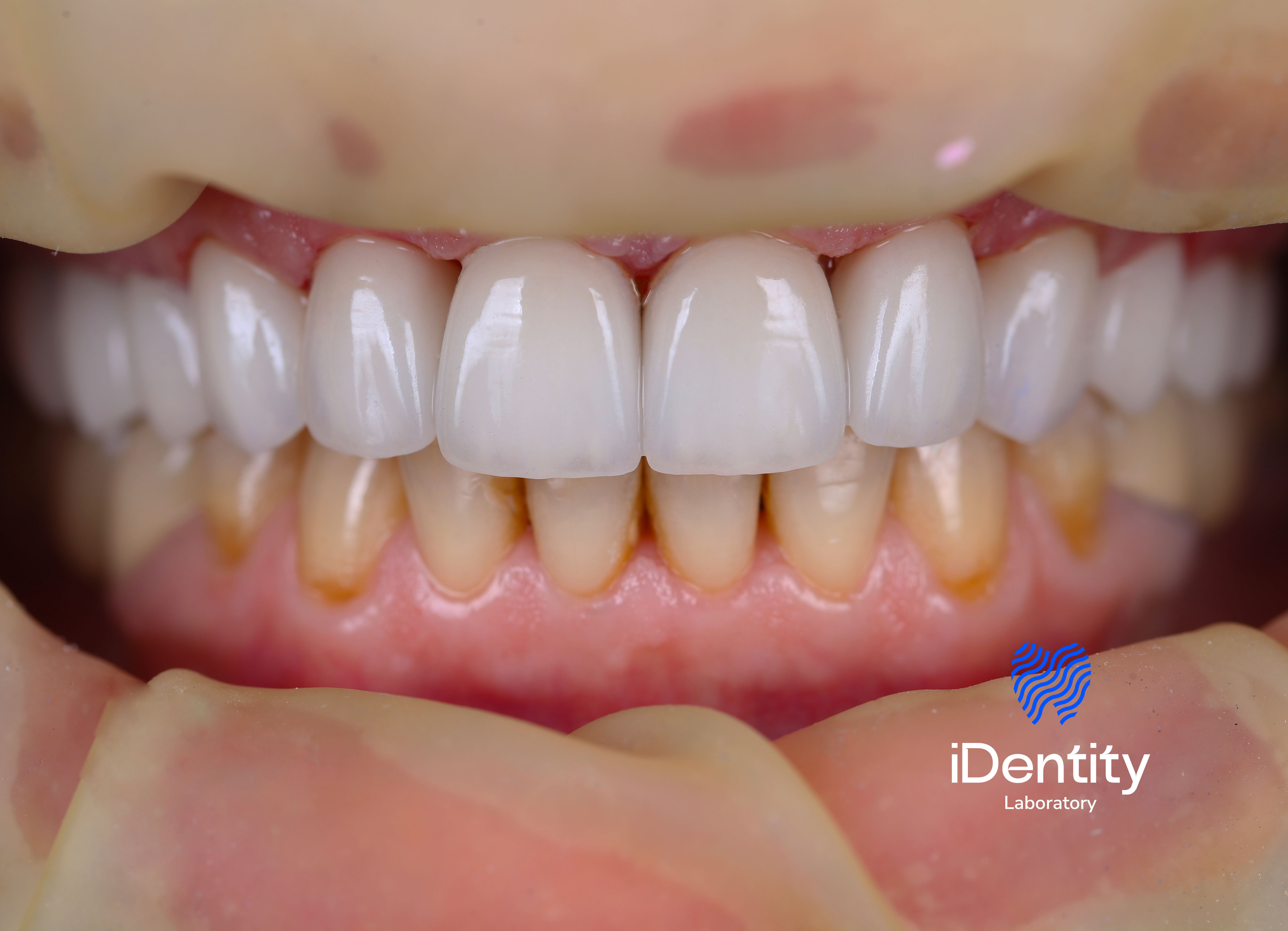 Close-up of upper front teeth with dental veneers or crowns, lower teeth natural with some discoloration.