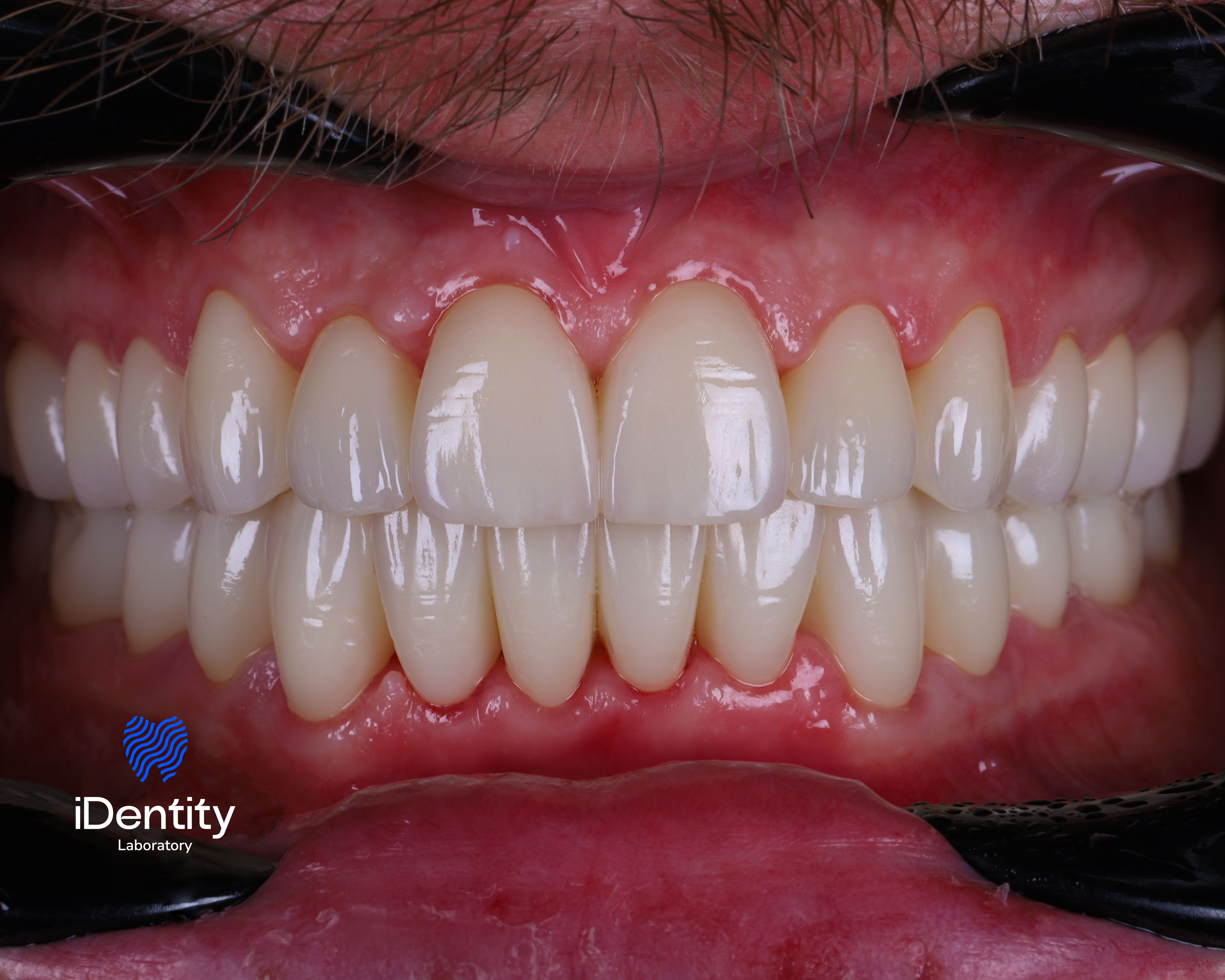 Close-up of a person's upper and lower teeth with healthy pink gums and clean, well-aligned teeth.