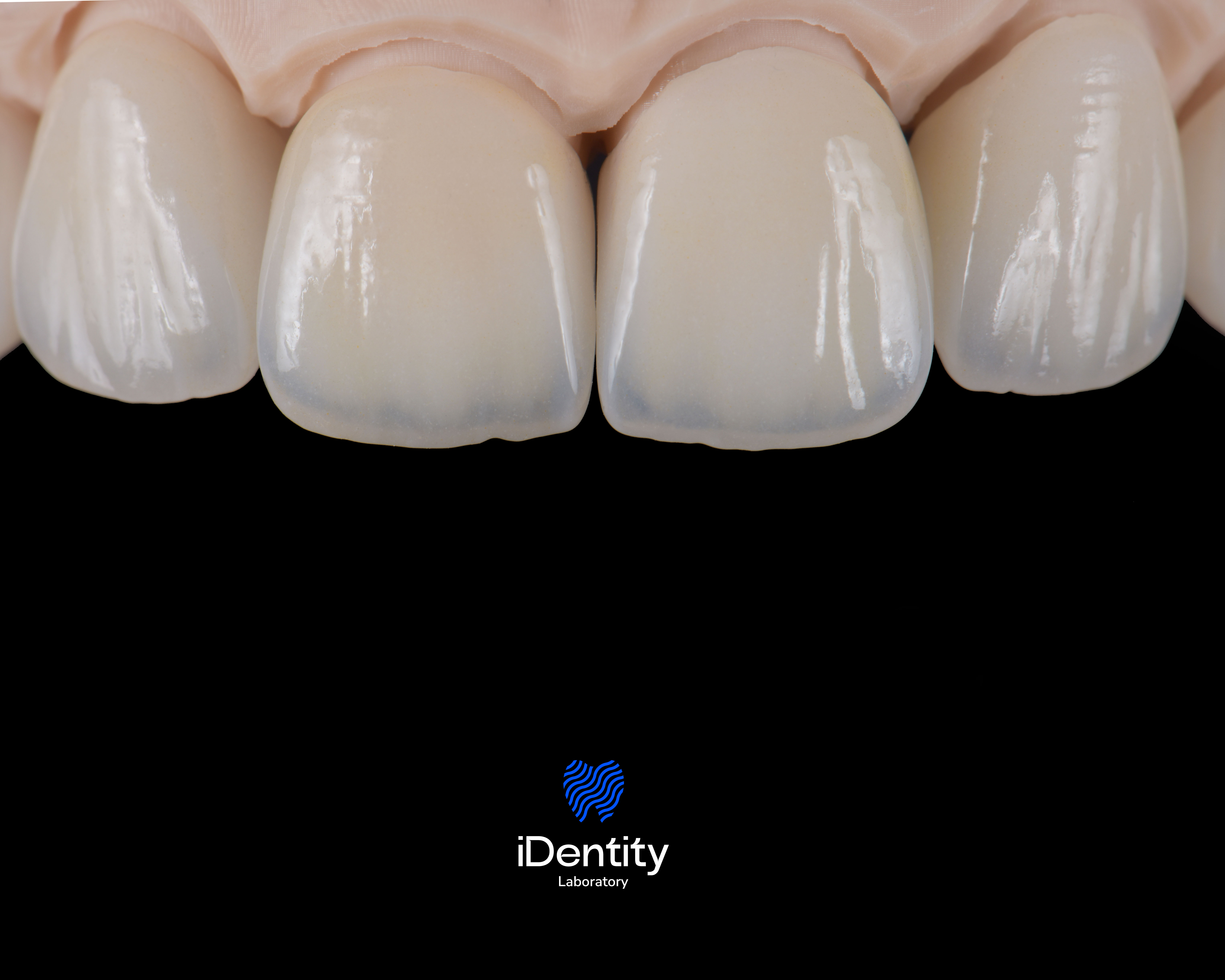 Close-up of four dental crowns on a model against a black background with iDentity Laboratory logo below.