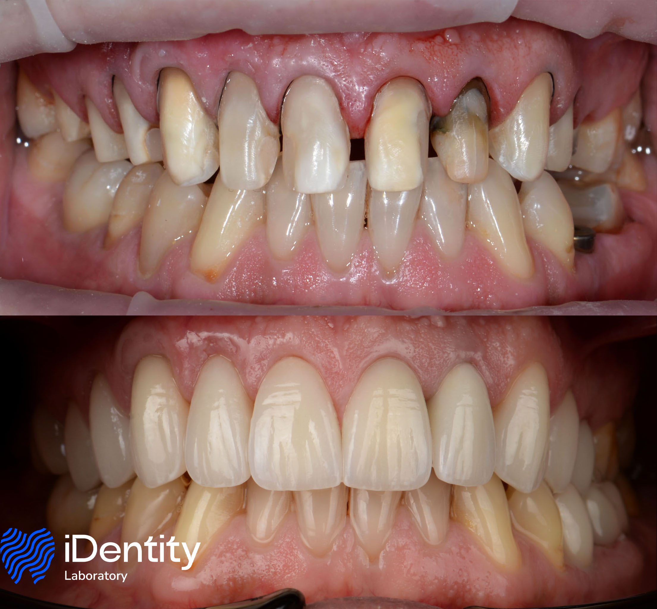 Close-up comparison of teeth before and after dental restoration showing worn, discolored upper teeth transformed into even, white teeth with improved appearance.