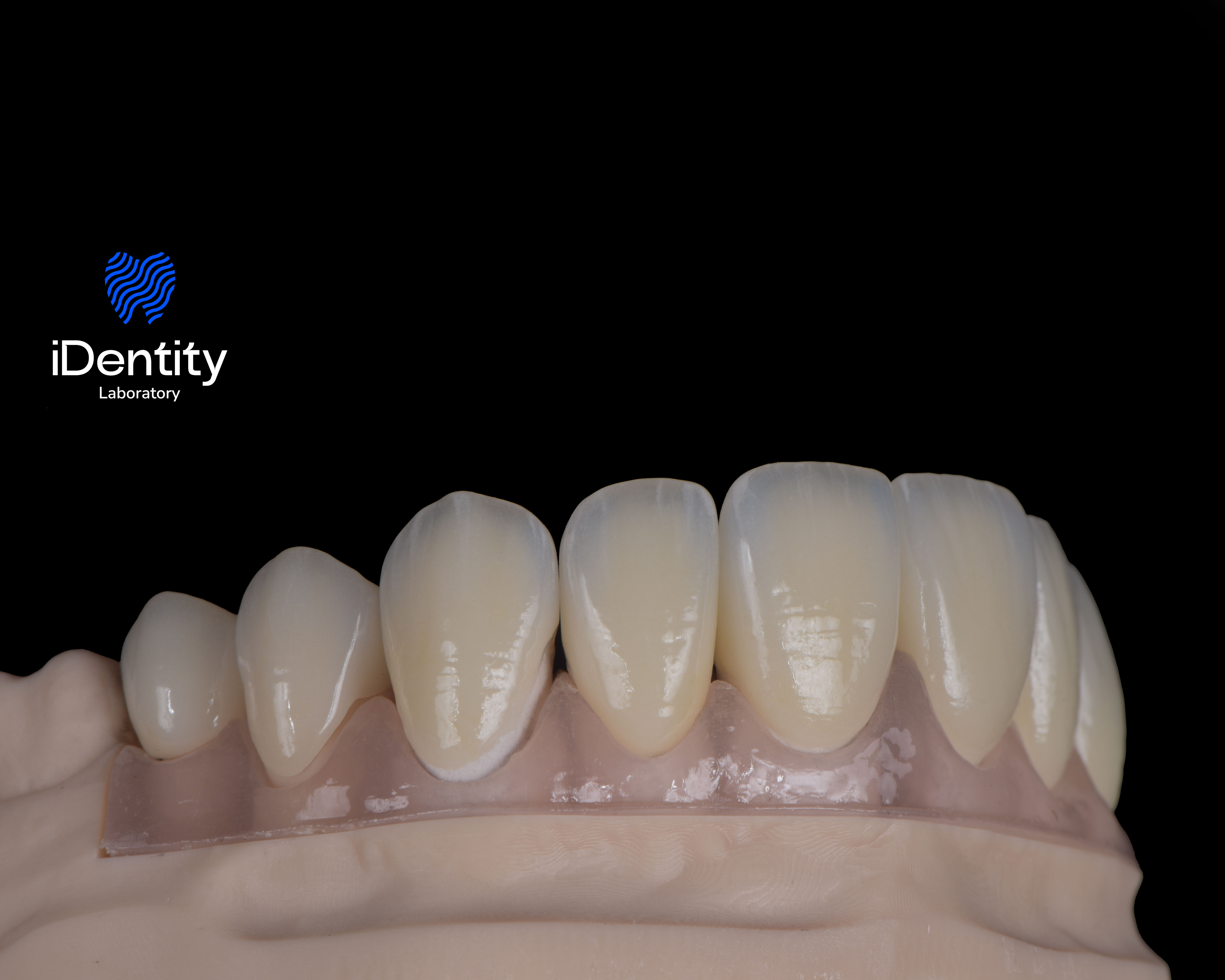 Close-up of a dental model showing upper front teeth with a transparent aligner on a black background.
