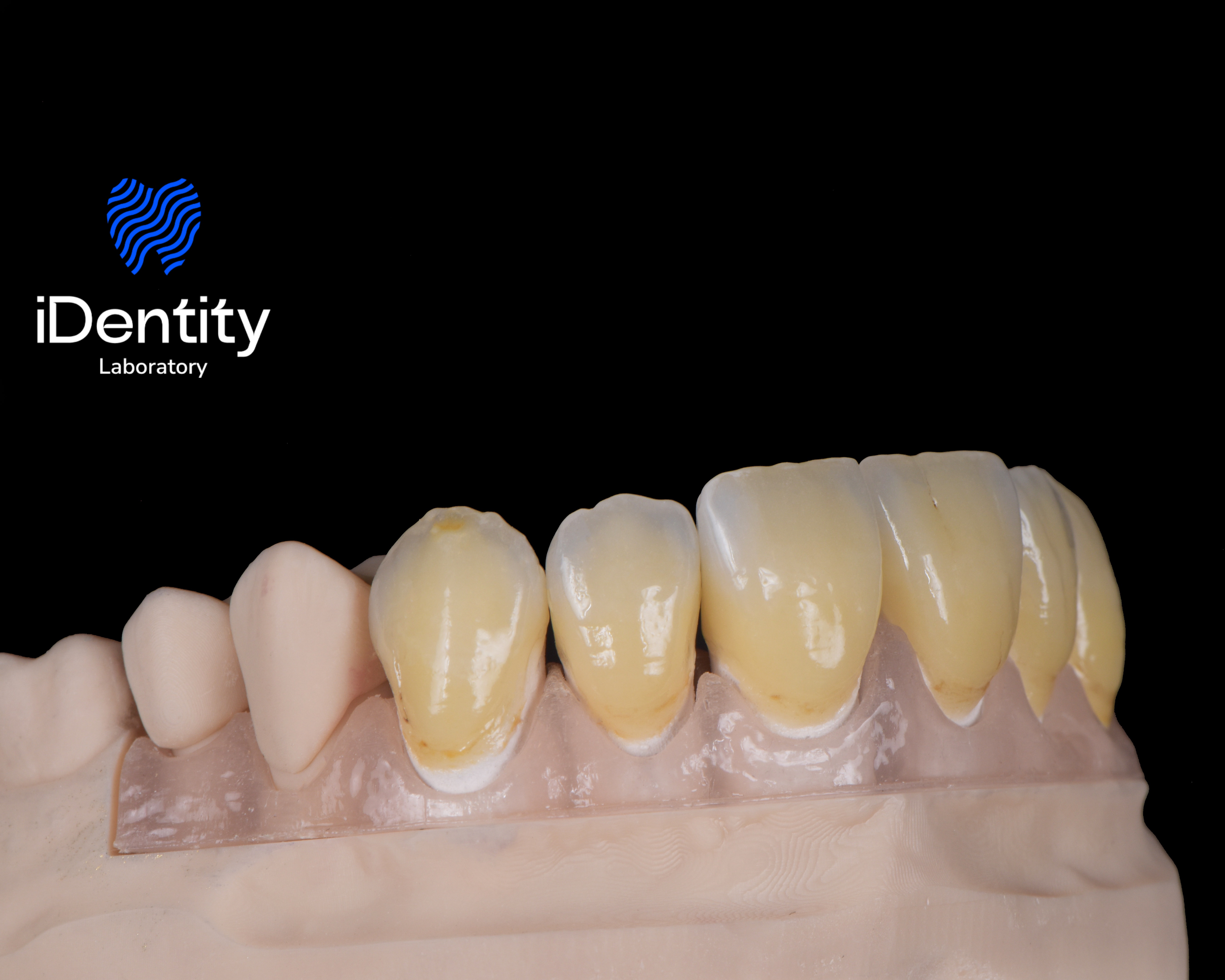 Dental model showing upper front teeth with some teeth covered by a transparent dental guide.