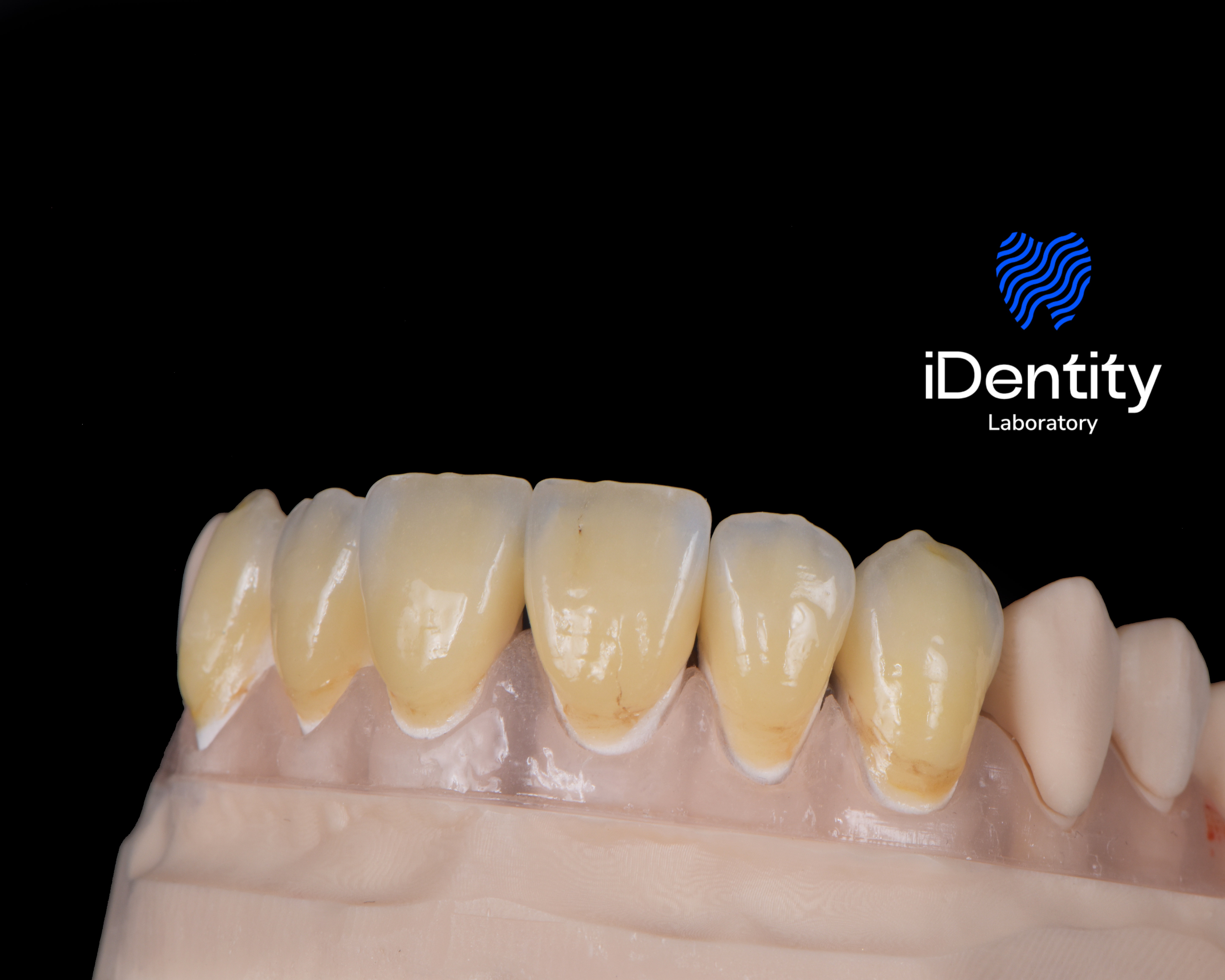 Close-up of dental model showing yellowed upper front teeth on a black background with iDentity Laboratory logo.