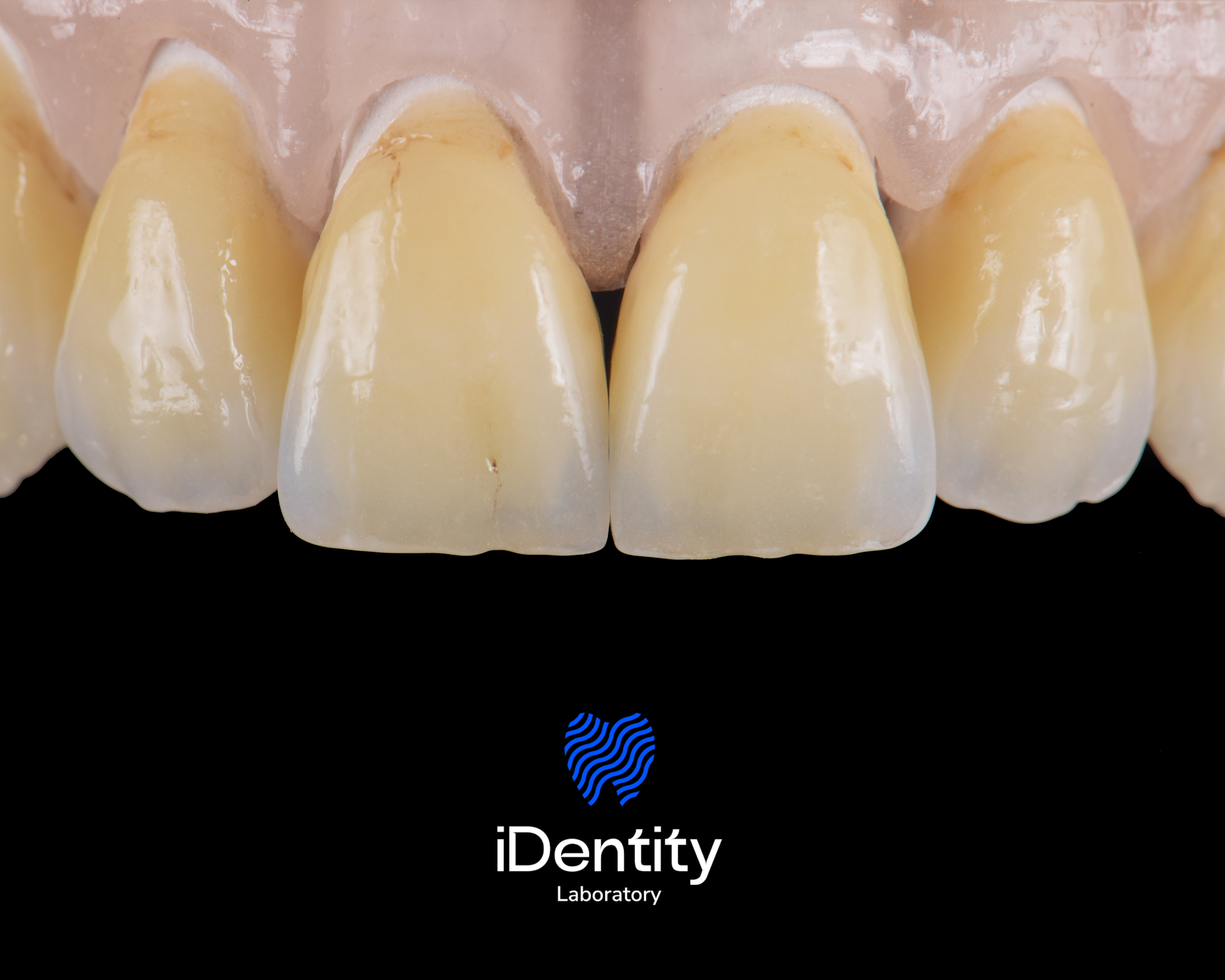 Close-up of four upper front teeth with visible dental staining and wear, above black background with blue tooth-shaped logo and text 'iDentity Laboratory'.