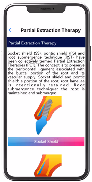 Mobile screen showing educational content on Partial Extraction Therapy, explaining socket shield, pontic shield, and root submergence techniques with a colored dental diagram.