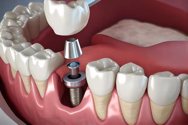 Імплантація