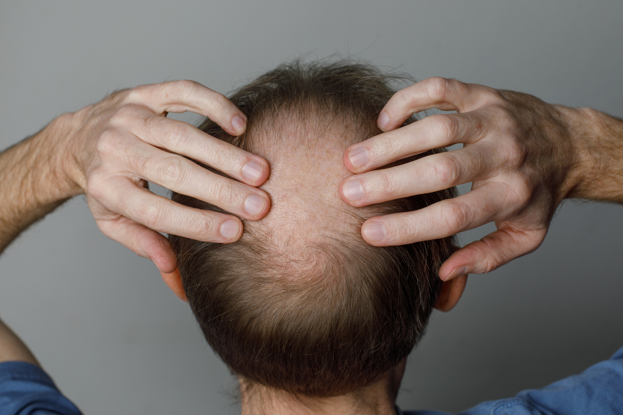 Top view of a person's crown showing visible thinning hair, demonstrating the progression of pattern hair loss in the 30s.