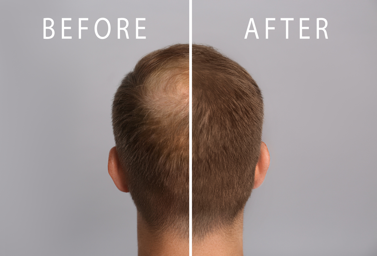 Before-and-after comparison of crown hair density, showing improved hair growth after consistent hair loss treatment.