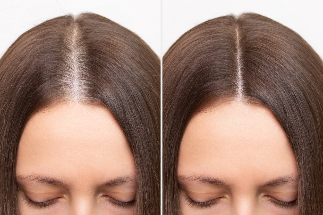 Before-and-after comparison showing improved hair density and reduced scalp visibility following female pattern hair loss treatment.