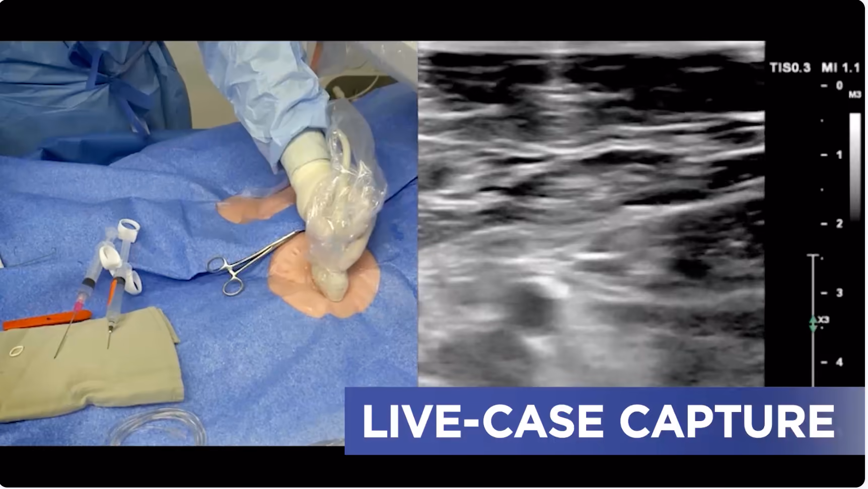 Medical scene showing a gloved hand holding an ultrasound probe on a patient's covered arm next to syringes and medical tools, with an ultrasound image on the right and the text 'LIVE-CASE CAPTURE' at the bottom.