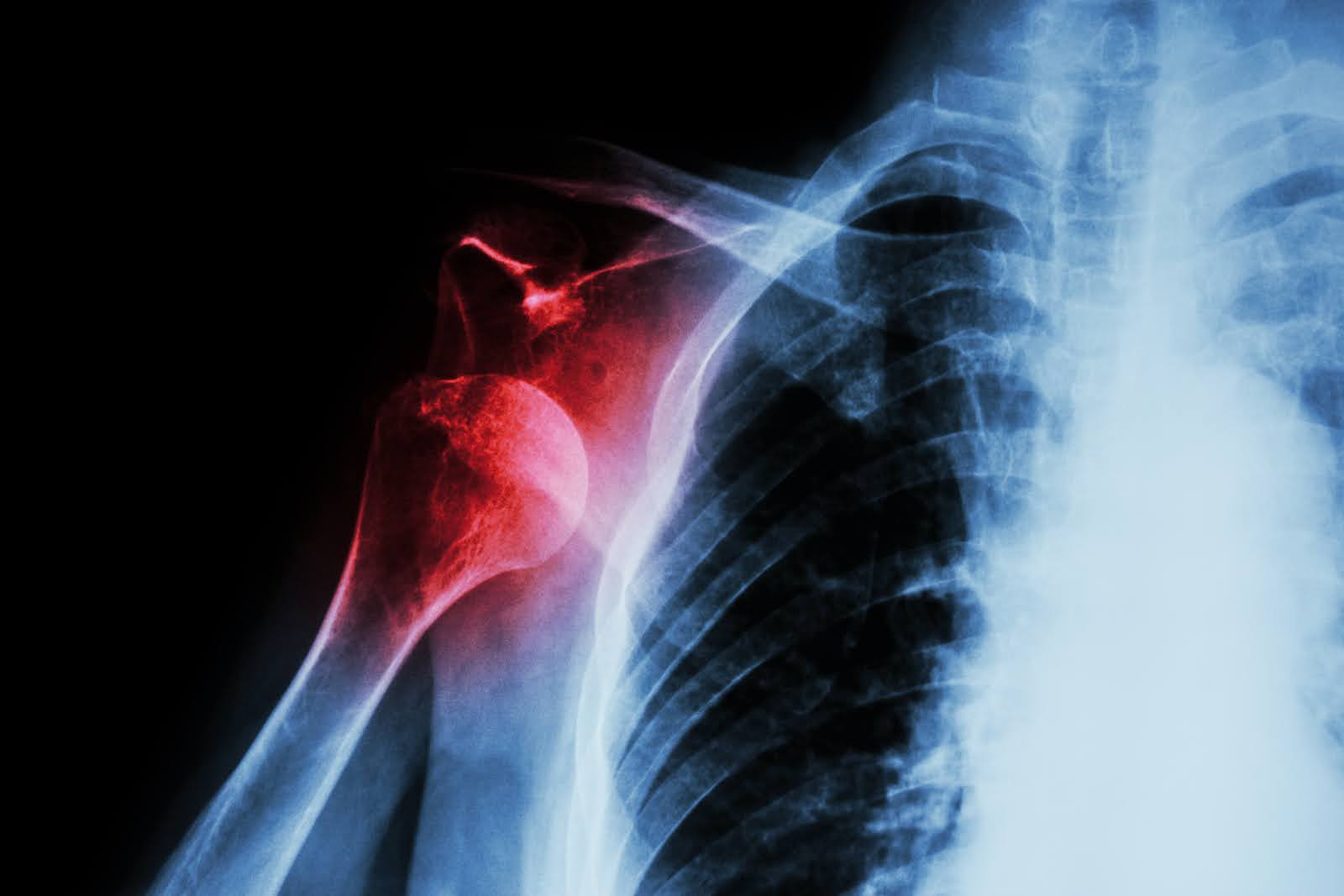 X-ray image of shoulder showing joint condition - diagnostic imaging for shoulder surgery
