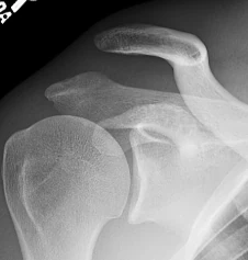 X-ray of an AC joint dislocation at the top of the shoulder