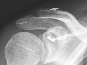 X-ray after tightrope repair of the AC joint, showing two small metal buttons