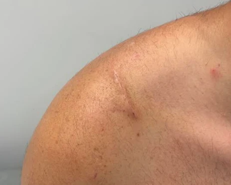 Small scar on the top of the shoulder after tightrope repair of the AC joint