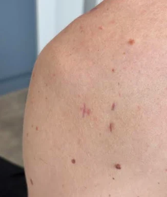 Small keyhole scars on the back of the shoulder 4 months after keyhole bone block surgery