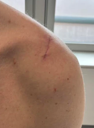 Small scar on the front of the shoulder 4 months after keyhole bone block surgery