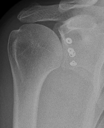 X-ray after keyhole bone block surgery, with the bone graft held by small round buttons