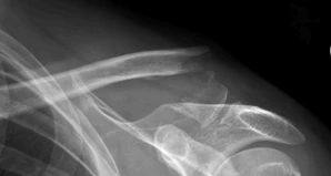 X-ray of a fracture at the outer end of the collarbone