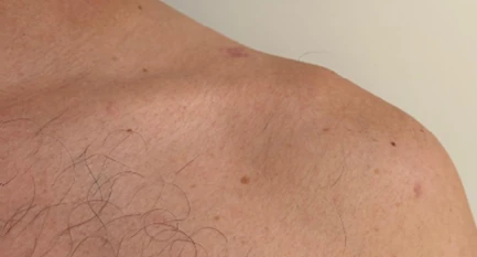 Small scars on the top of the shoulder after tightrope fixation of the collarbone