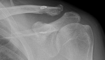 X-ray after tightrope fixation of the collarbone, showing two small metal buttons