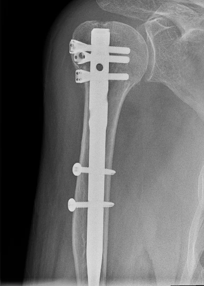 X-ray after fixation with an intramedullary nail running down the inside of the arm bone