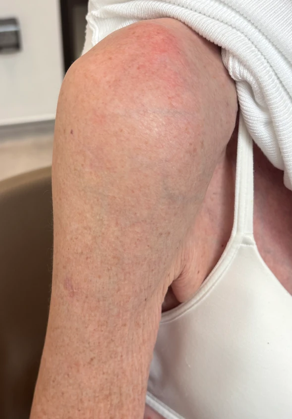 Small scars on the top and outer side of the shoulder after nail fixation