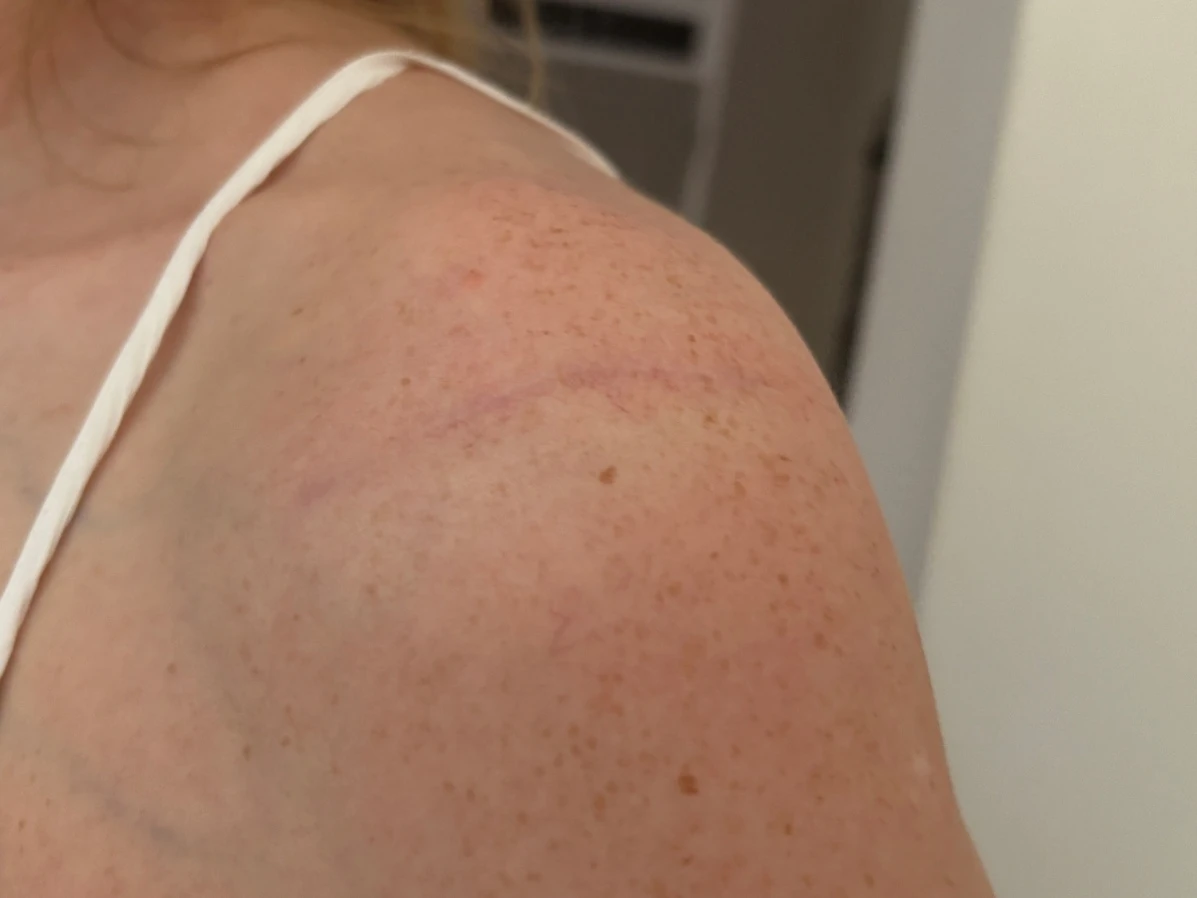 Scar on the front of the shoulder 6 months after PHAST fixation