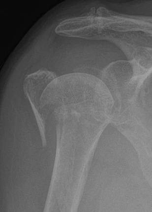 X-ray of a valgus impacted fracture at the top of the upper arm bone, before surgery