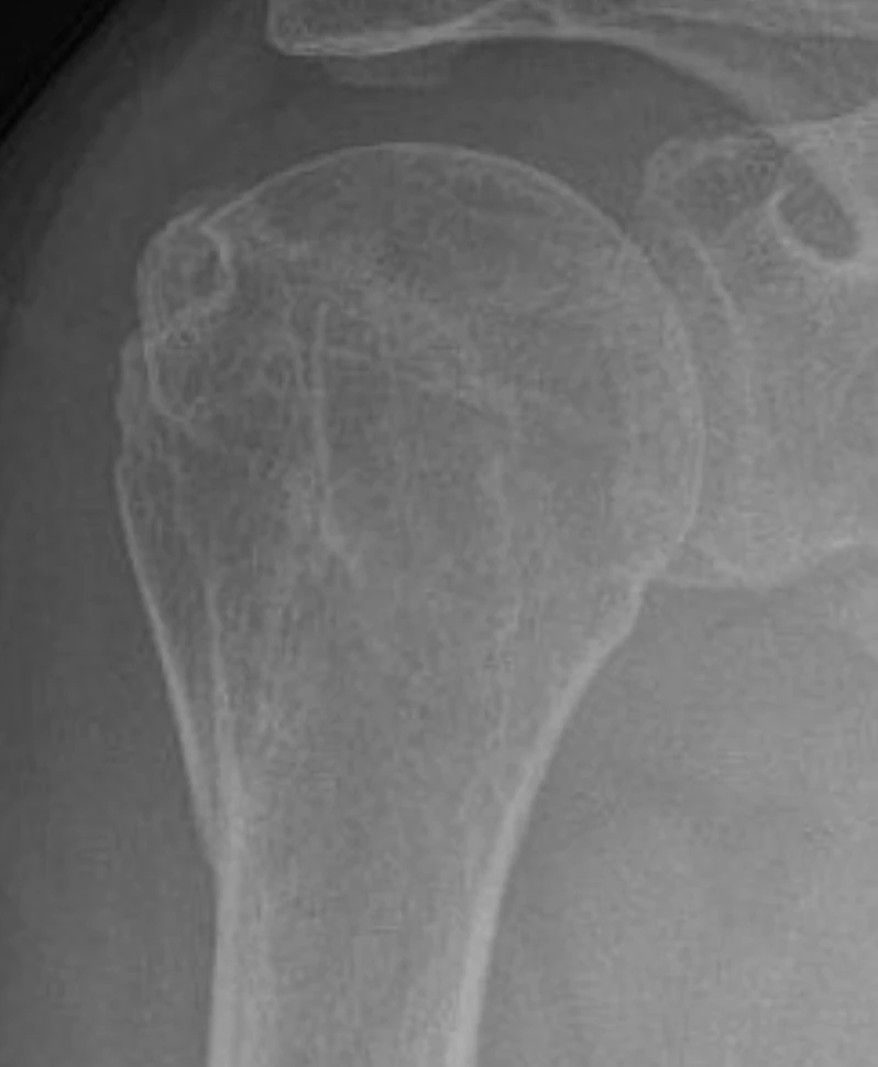 X-ray of the same shoulder after PHAST fixation, with no metal plate or screws