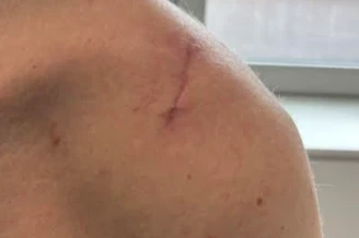 Small scar on the front of the shoulder 4 months after keyhole bone block surgery