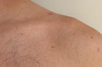 Small scars on the top of the shoulder after tightrope fixation of the collarbone