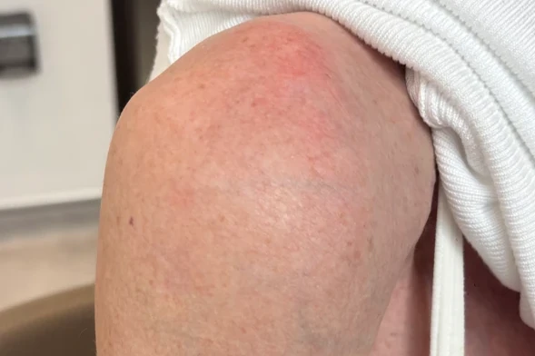 Small scars on the top of the shoulder after nail fixation