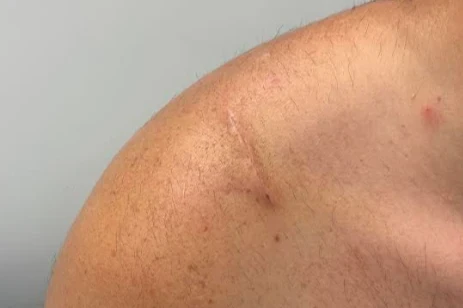 Small scar on the top of the shoulder after tightrope repair of the AC joint