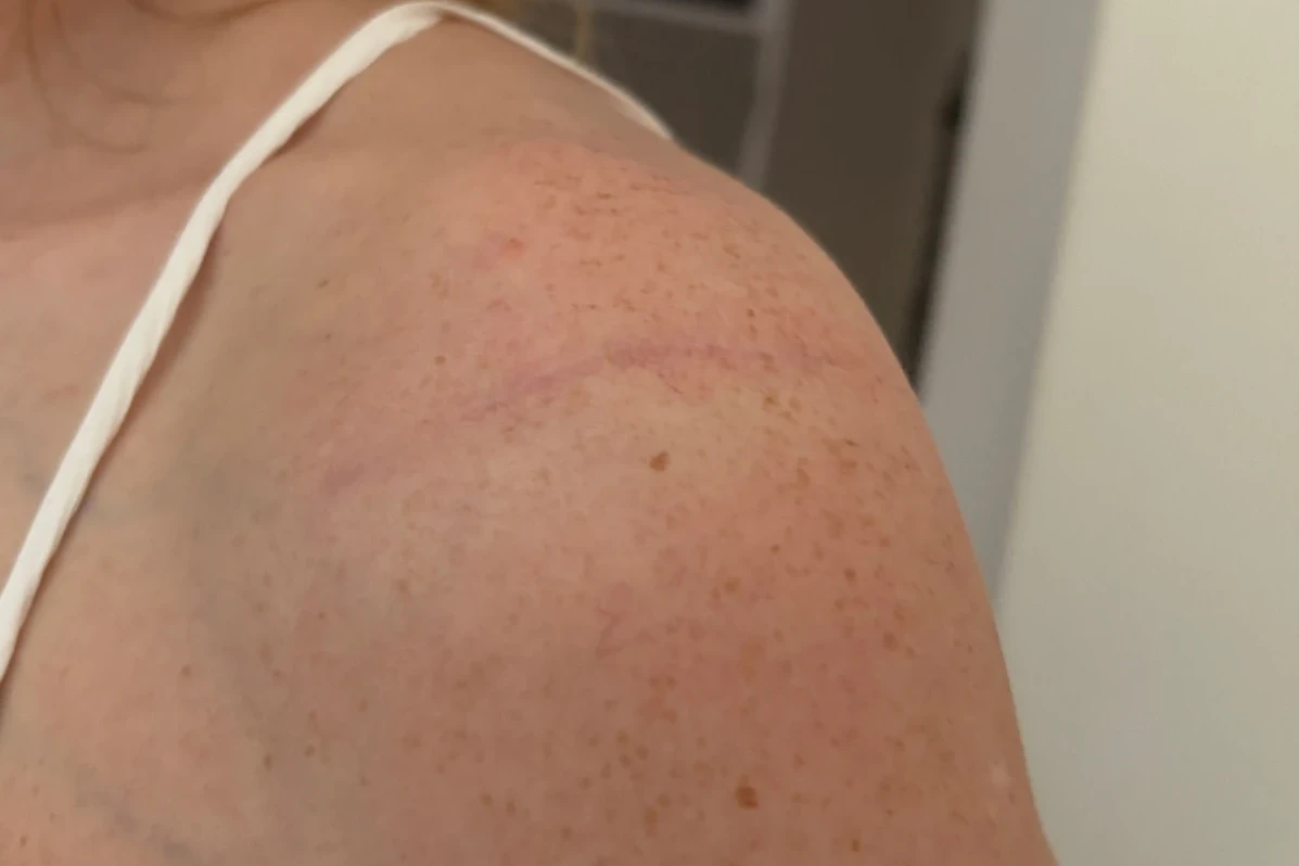 Scar on the front of the shoulder 6 months after PHAST fixation