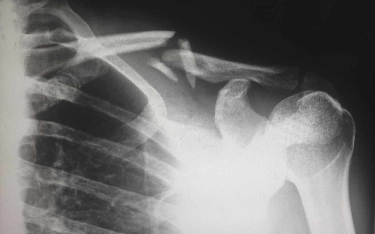 shoulder replacement — Pre-Surgery Preparations