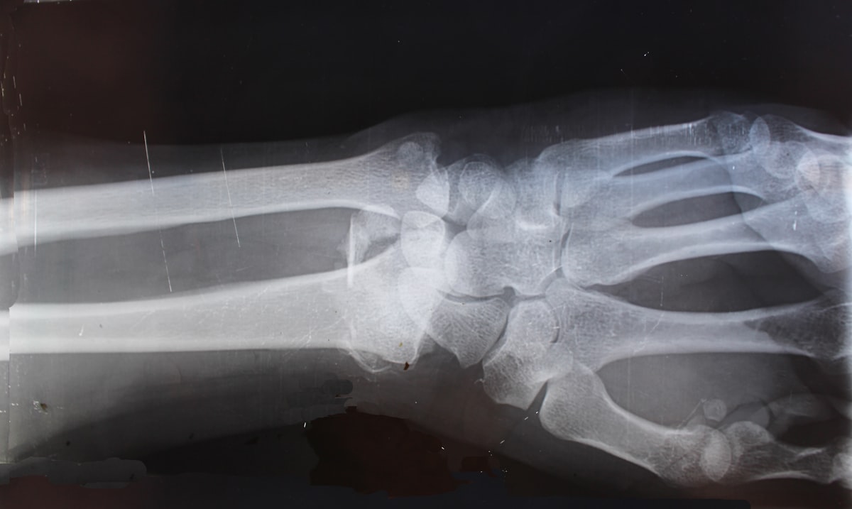 calcific tendonitis - painful — Definition and Overview