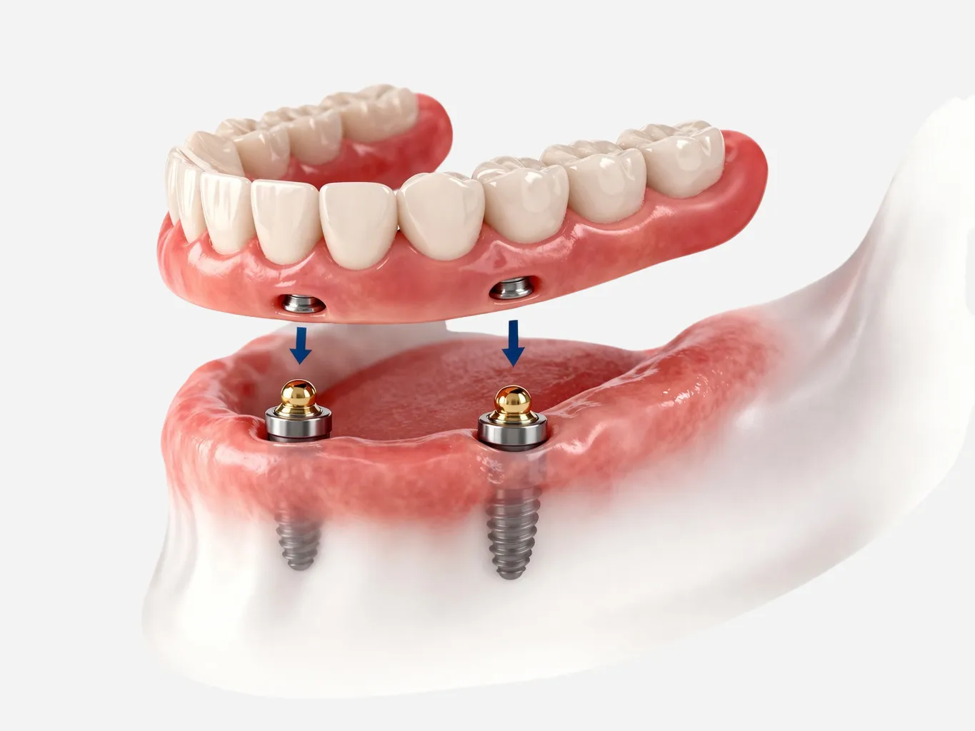 Denture with Zahnimplantat secured by implants at MKG Köln West Implantatzentrum in Köln.