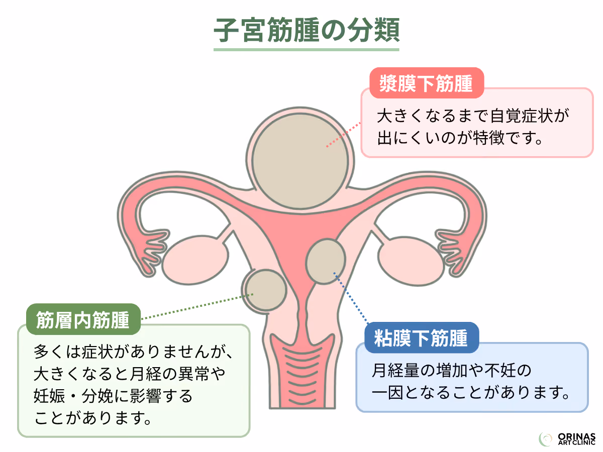 子宮筋腫の分類