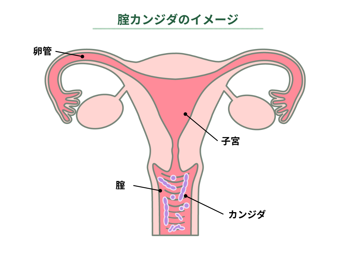 腟カンジダのイメージ