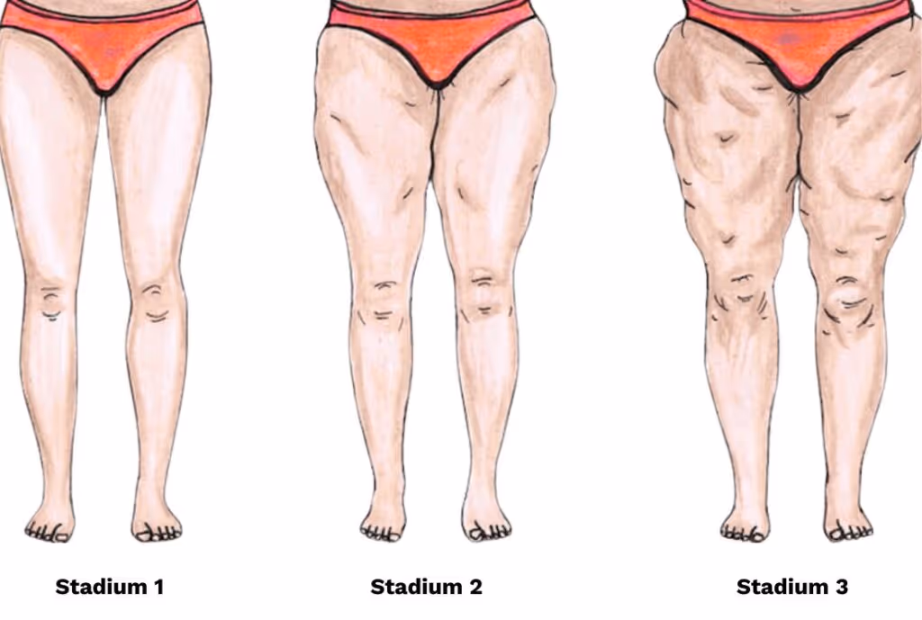 Illustration von drei Stadien des Lipödems bei Frauen. Links zeigt das Bild das Lipödem im Stadium 1 mit leichten Fettansammlungen an den Beinen, in der Mitte das Lipödem im Stadium 2 mit verstärkter Fetteinlagerung und deutlicherer Kontur an Oberschenkeln und Knien, und rechts das Lipödem im Stadium 3 mit stark ausgeprägten Fettpolstern und Verformungen. Die Grafik visualisiert die fortschreitenden Veränderungen im Erscheinungsbild der Beine durch das Lipödem, insbesondere im Stadium 2, in dem die Fettansammlungen zunehmend auffallen.