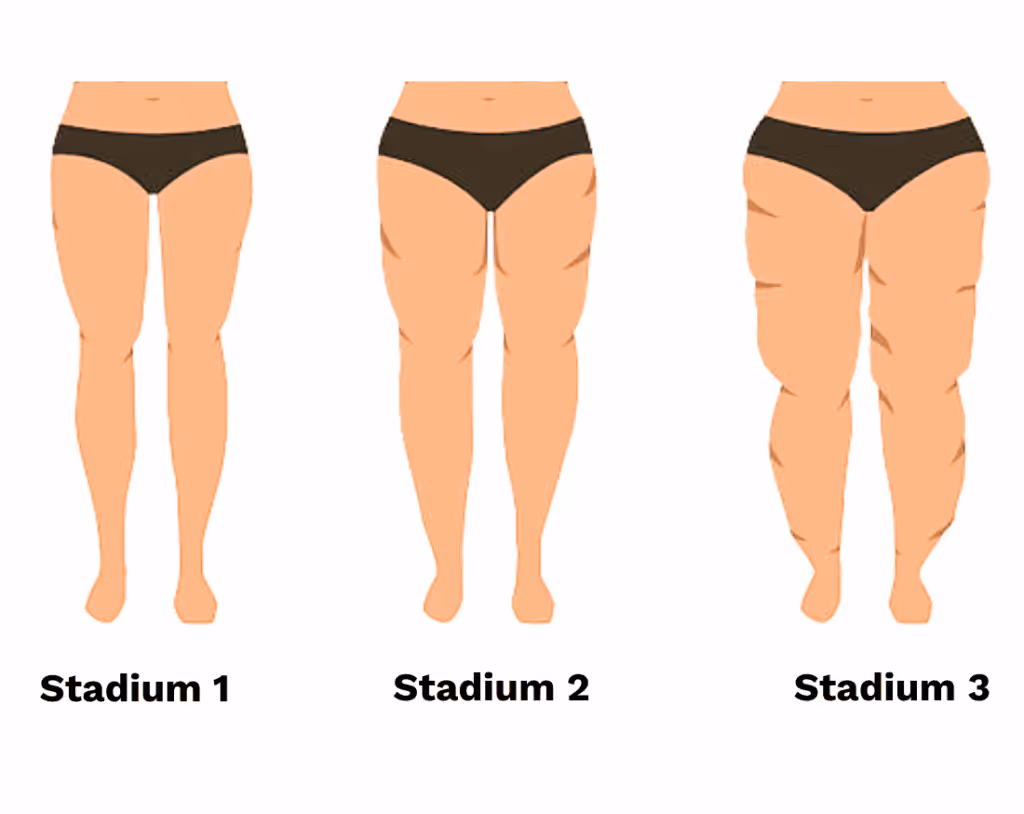 Grafik von drei Stadien des Lipödems bei Frauen. Links zeigt das Bild das Lipödem im Stadium 1 mit leichten Fettansammlungen an den Beinen, in der Mitte das Lipödem im Stadium 2 mit verstärkter Fetteinlagerung und deutlicherer Kontur an Oberschenkeln und Knien, und rechts das Lipödem im Stadium 3 mit stark ausgeprägten Fettpolstern und Verformungen.