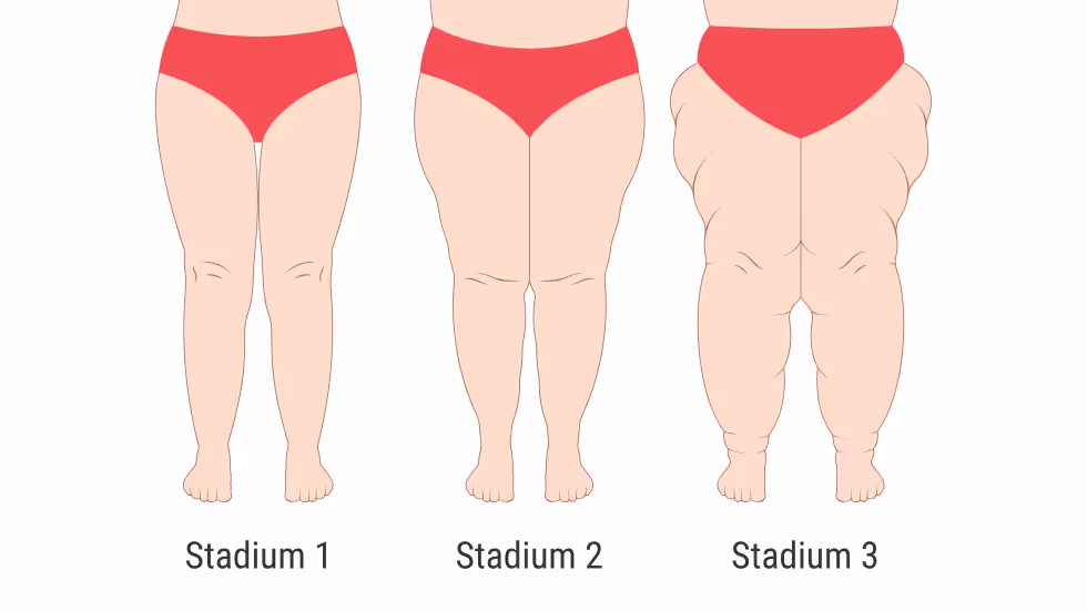 Darstellung der verschiedenen Lipödem Stadien an den Beinen