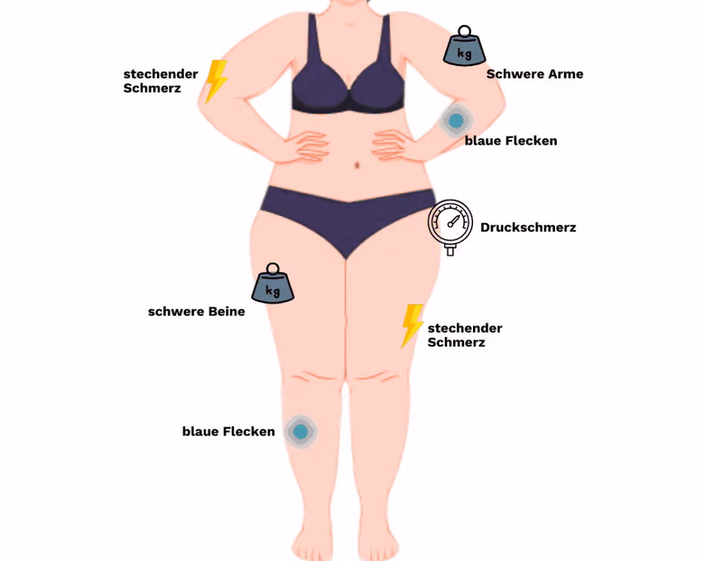 Illustration der häufigsten Symptome bei Lipödem – blaue Flecken, Druckschmerz, schwere Beine und stechende Schmerzen.