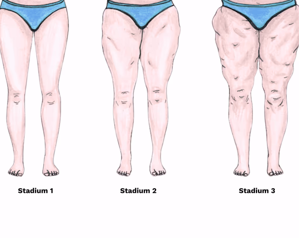 Grafische Darstellung der drei Stadien des Lipödems mit wachsender Gewebeveränderung und Umfangszunahme der Beine.