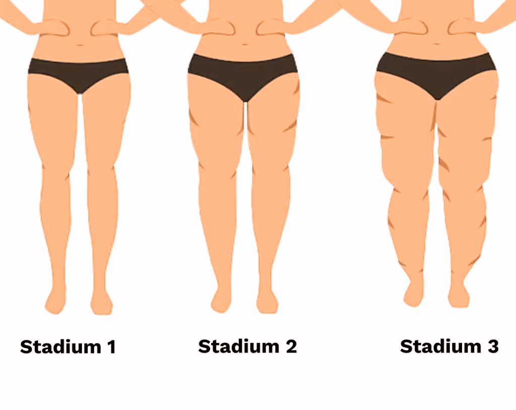 Illustration der drei Stadien einer Fettverteilungsstörung: Von leichter Schwellung bis stark ausgeprägten Fettansammlungen an Beinen und Hüfte. Hilfreich zur Einordnung des eigenen Lipödem-Stadiums.