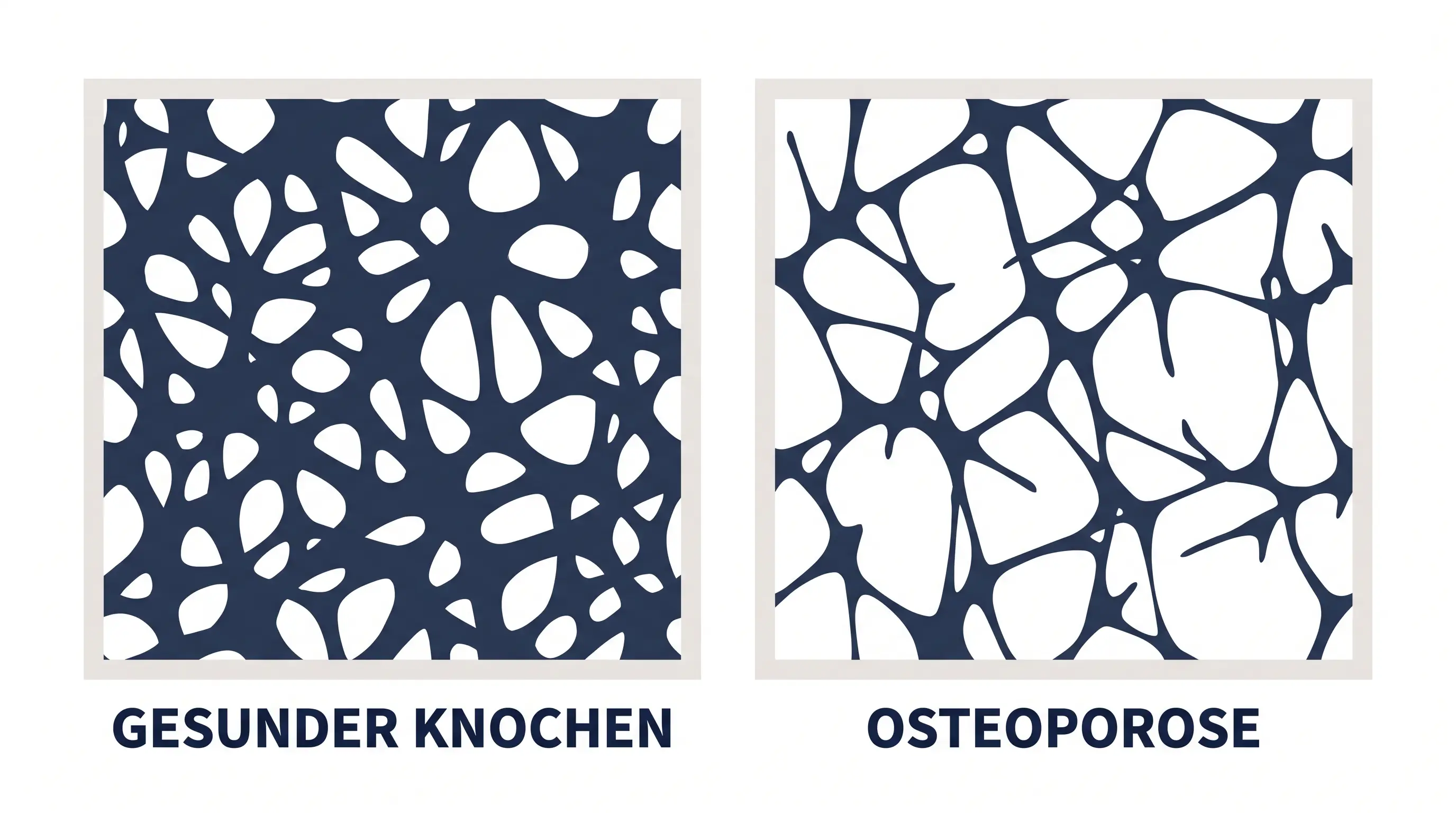 Grafik im Querschnitt, die gesundes Knochengerüst und poröses Knochengerüst bei Osteoporose nebeneinanderstellt