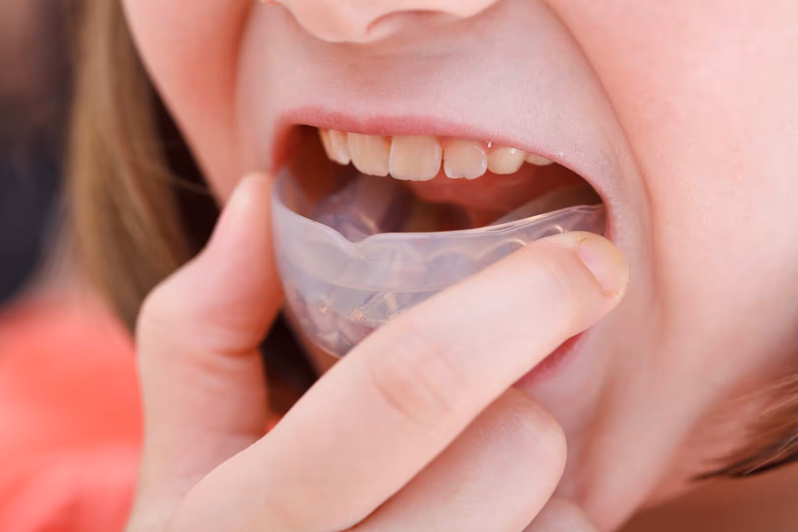 Occlusal & Sports Mouth Guards