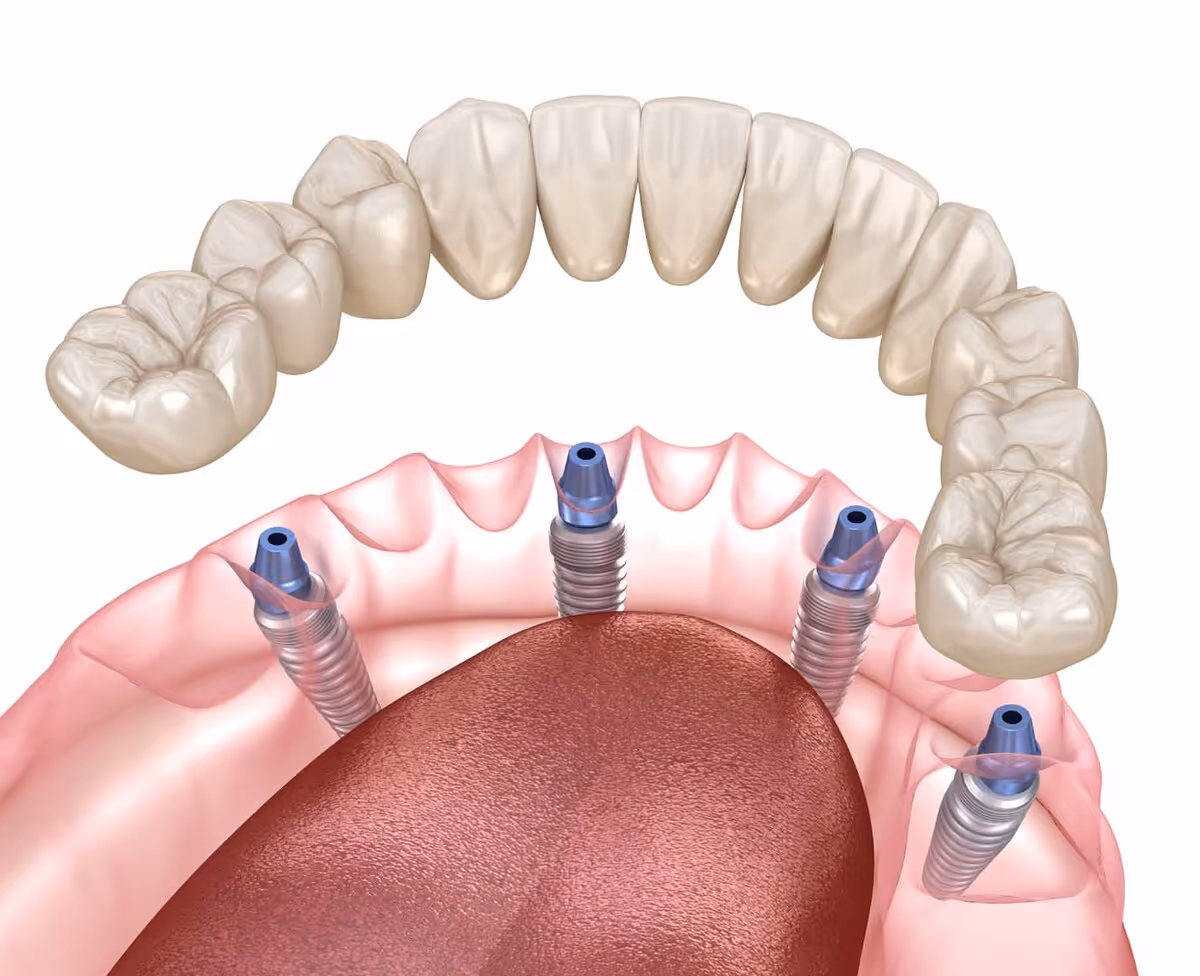 Implant-Supported Dentures
